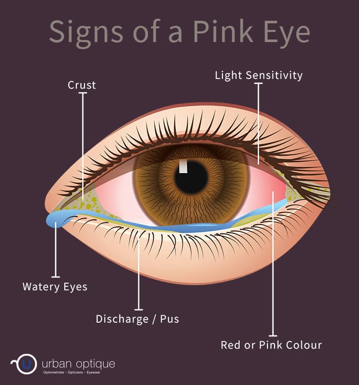 Diagram showing the symptoms of pink eye/conjunctivitis