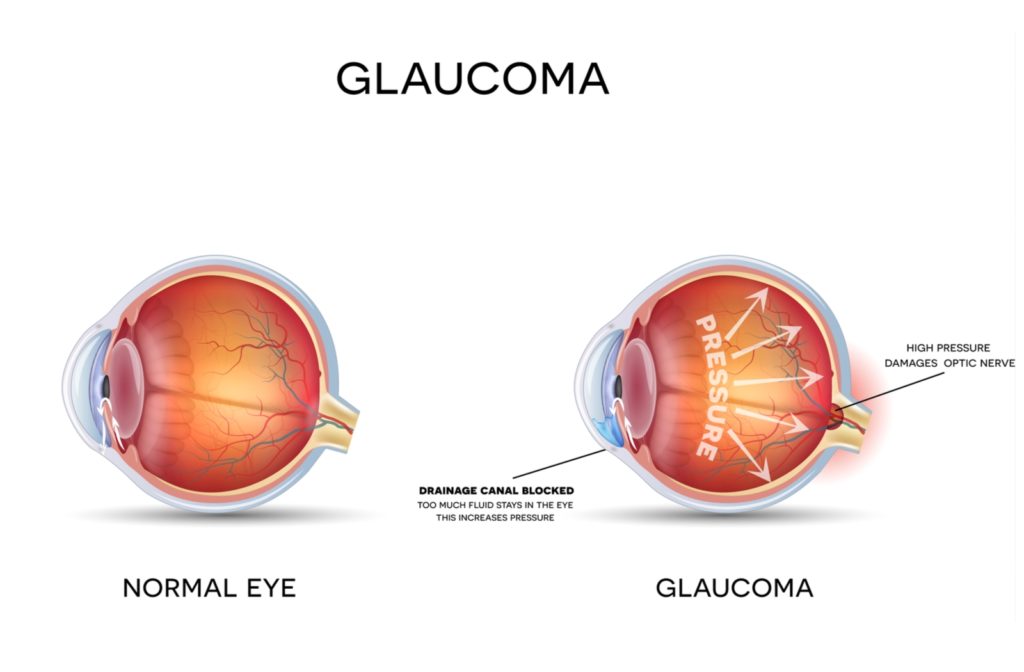 The detailed structure of both a normal eye and an eye that is experiencing the effects of glaucoma with the drainage canal blocked and high pressure on the optic nerve