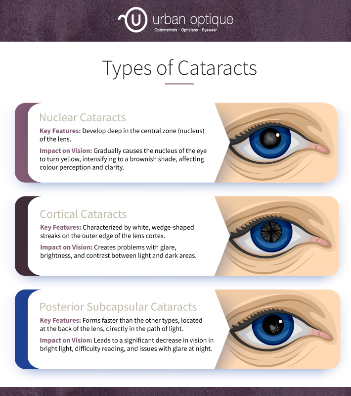 visual representation of Types of cataracts 