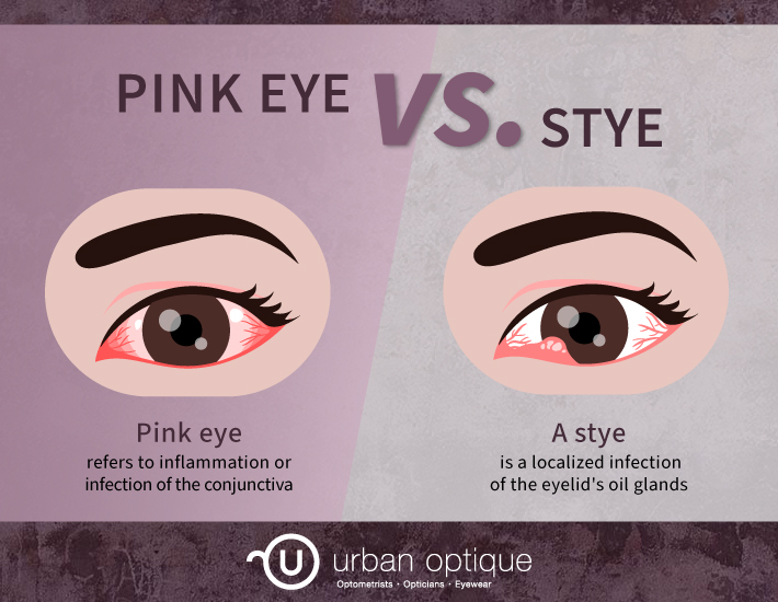 an infographic showing the difference between symptoms of pink eye and stye.